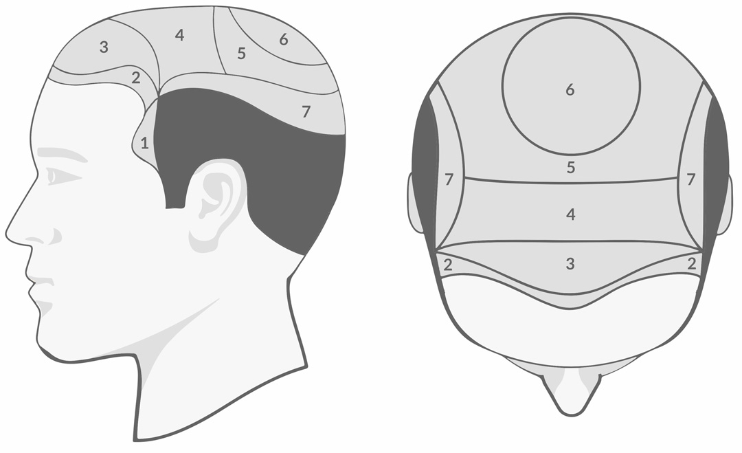 Procedure To Determine How Many Grafts Needed