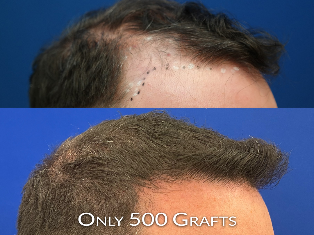 jeff-right-oblique-view-only-500-grafts