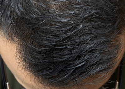 What is Micro FUE?