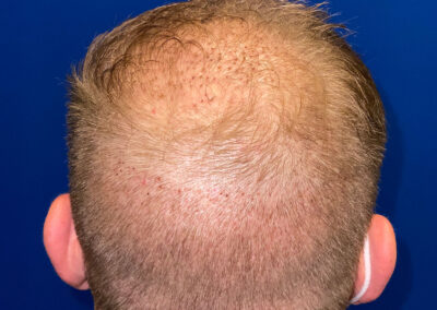 Why choose a Micro FUE procedure?