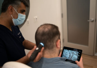 What are the limitations of a Micro FUE?
